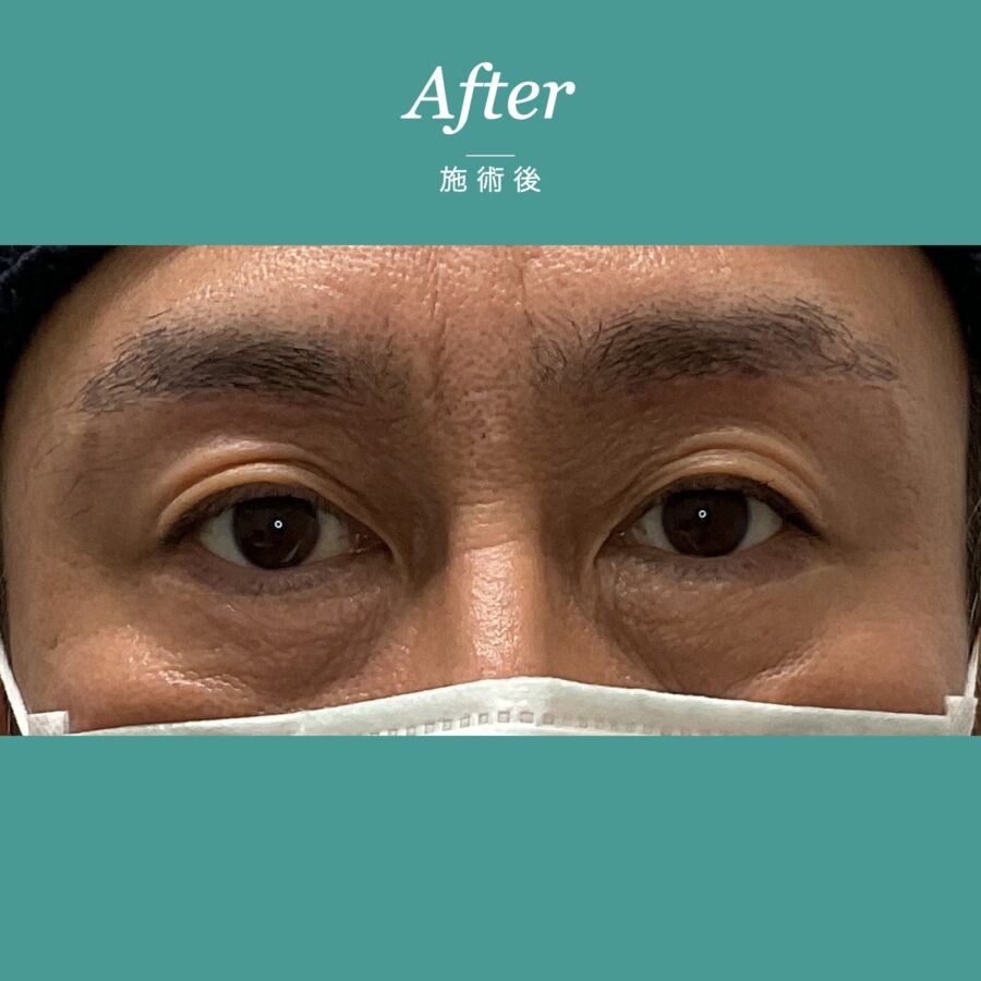 眉下切開 施術後