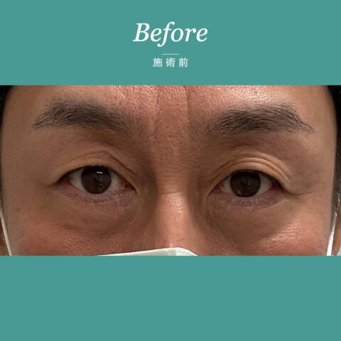 眉下切開 施術前