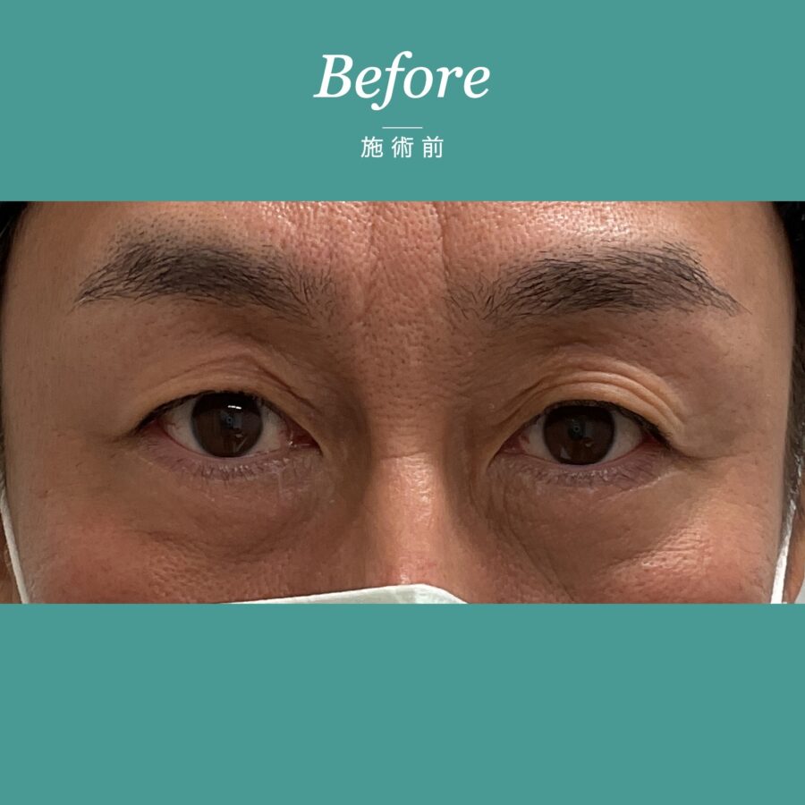 眉下切開 施術前