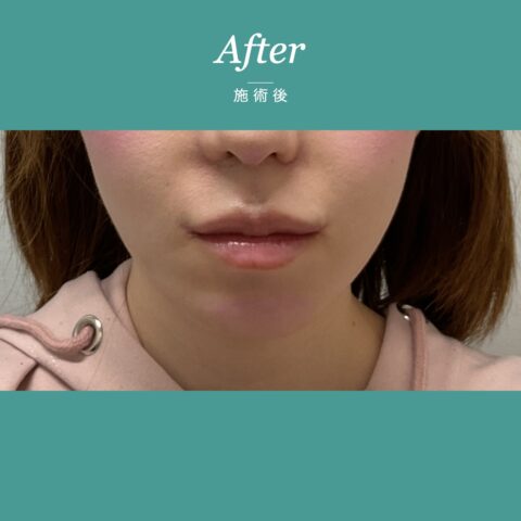 糸リフト（PCL） 施術後