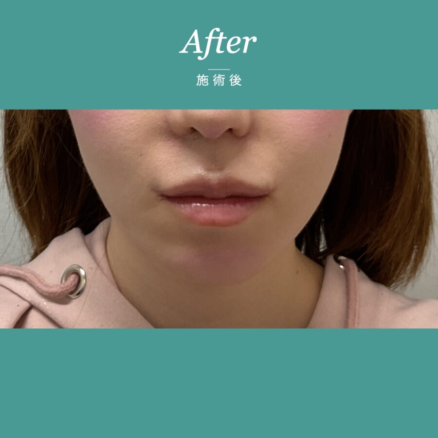 糸リフト（PCL） 施術後
