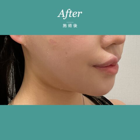 糸リフト(PDO) 施術後
