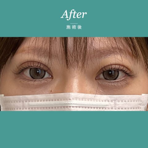 二重埋没法（４点留め） 施術後
