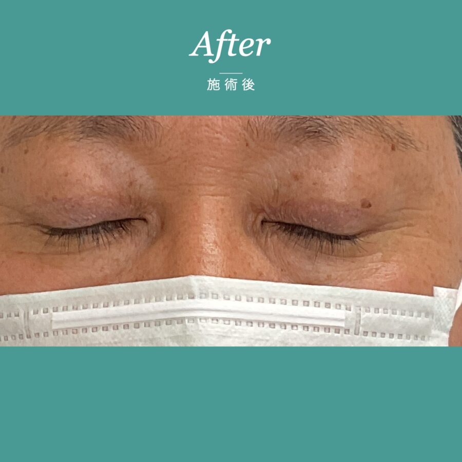 眼瞼下垂（目が開きにくく眠たそうに見える事例） 施術後（2枚目）