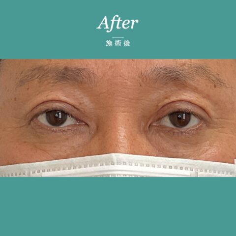 眼瞼下垂（目が開きにくく眠たそうに見える事例） 施術後