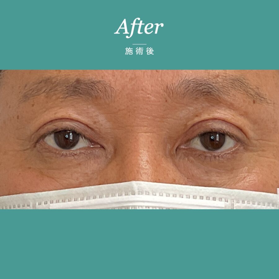 眼瞼下垂（目が開きにくく眠たそうに見える事例） 施術後