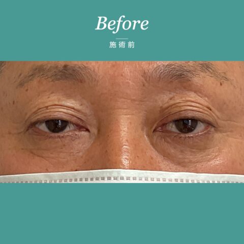眼瞼下垂（目が開きにくく眠たそうに見える事例） 施術前