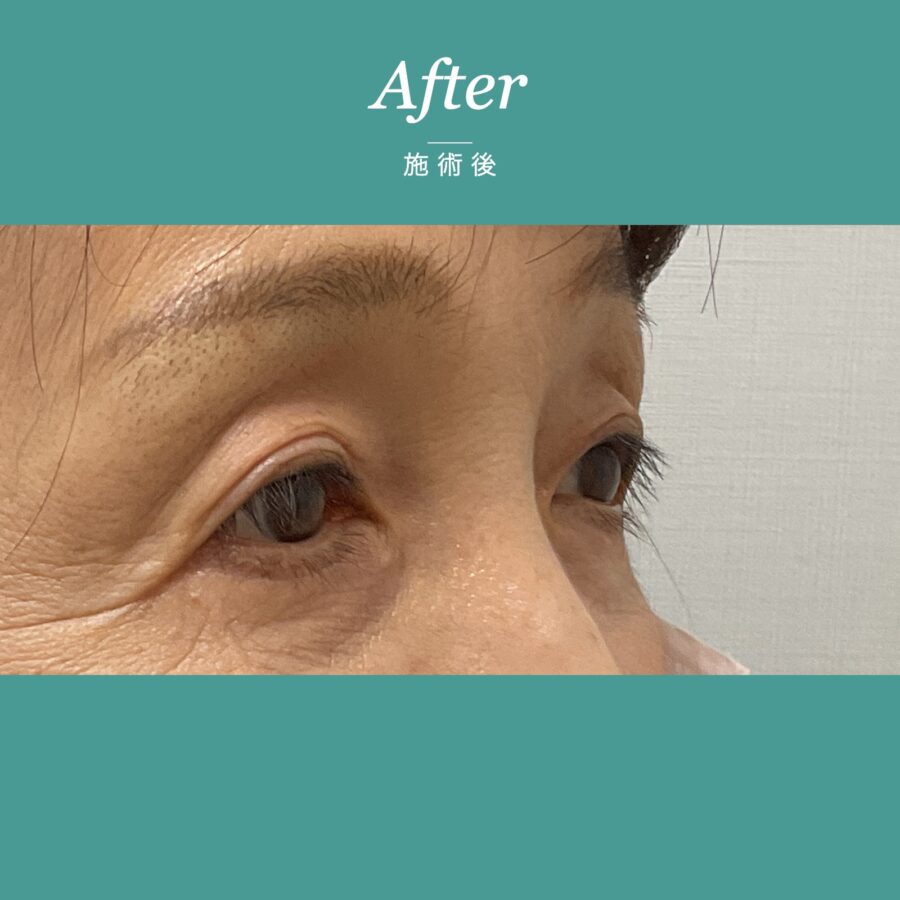 眼瞼下垂（二重ラインの自然な仕上がり事例） 施術後（2枚目）