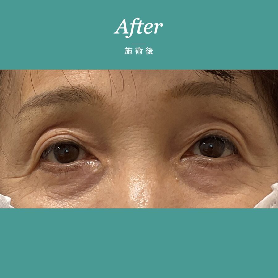 眼瞼下垂（二重ラインの自然な仕上がり事例） 施術後