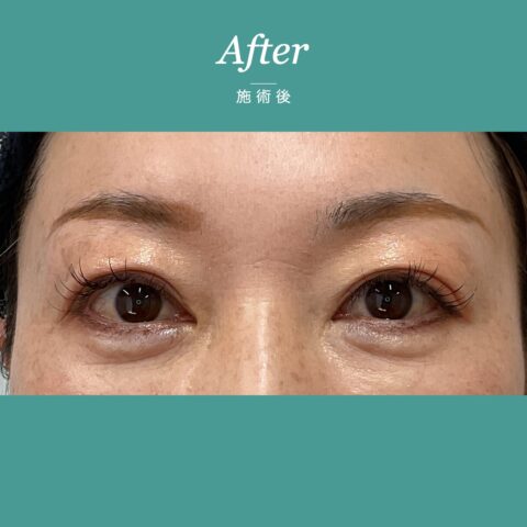 眼瞼下垂（二重のラインが不明瞭な事例） 施術後