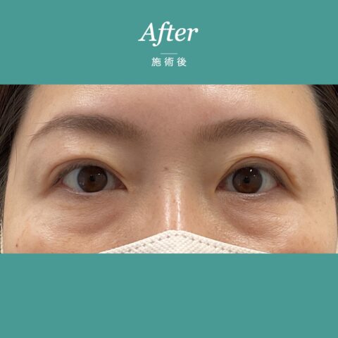 眼瞼下垂(保険適用:まぶたの重さと視界の狭さに悩まれた事例) 施術後