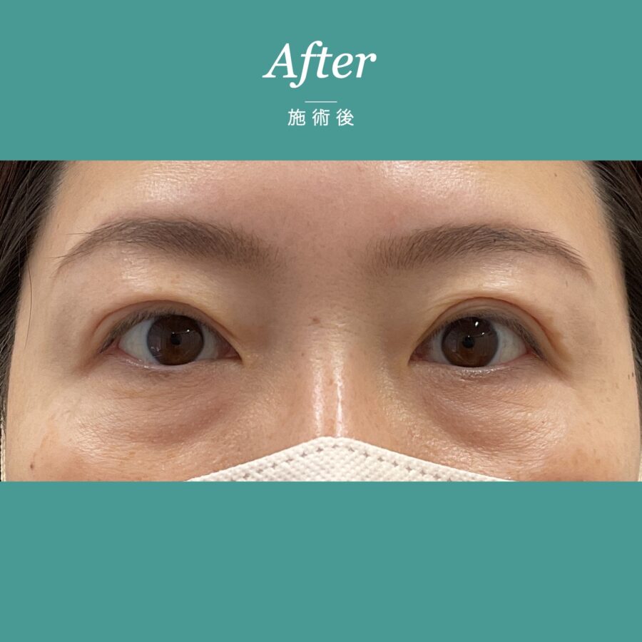 眼瞼下垂（保険適用:まぶたの重さと視界の狭さに悩まれた事例) 施術後