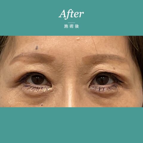 眼瞼下垂(保険適用:まぶたのかぶさり事例) 施術後
