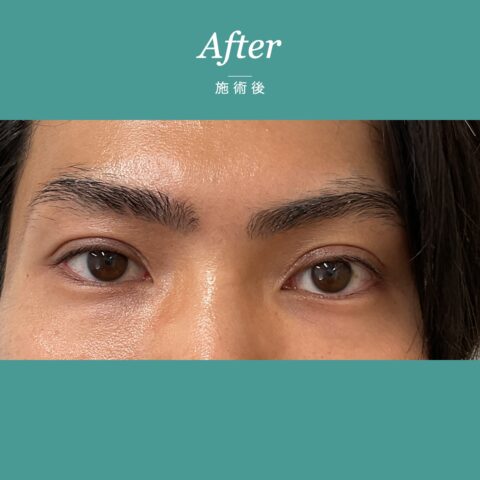 眼瞼下垂(保険適用:常に力んだ表情に見えることにお悩みの事例) 施術後