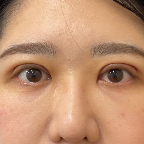 眼瞼下垂（保険適用:まぶたが黒目にかかる事例） 施術後
