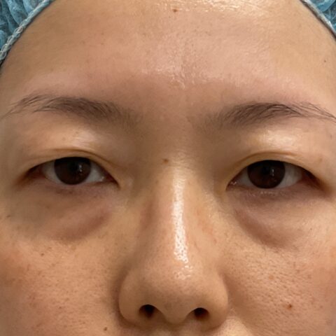 眼瞼下垂（保険適用:まぶたの重さと視界の狭さに悩まれた事例) 施術前
