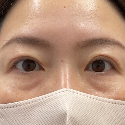 眼瞼下垂（保険適用:まぶたの重さと視界の狭さに悩まれた事例) 施術後