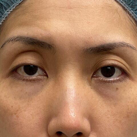眼瞼下垂（保険適用：まぶたが開きづらい事例） 施術前
