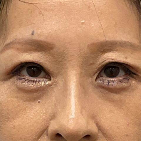 眼瞼下垂（保険適用：まぶたのかぶさり事例） 施術後