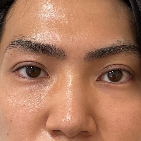 眼瞼下垂（保険適用：常に力んだ表情に見えることにお悩みの事例） 施術後