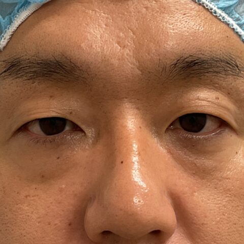 眼瞼下垂（保険適用：目の疲れにお悩みの事例） 施術前
