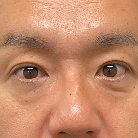 眼瞼下垂（保険適用：目の疲れにお悩みの事例） 施術後