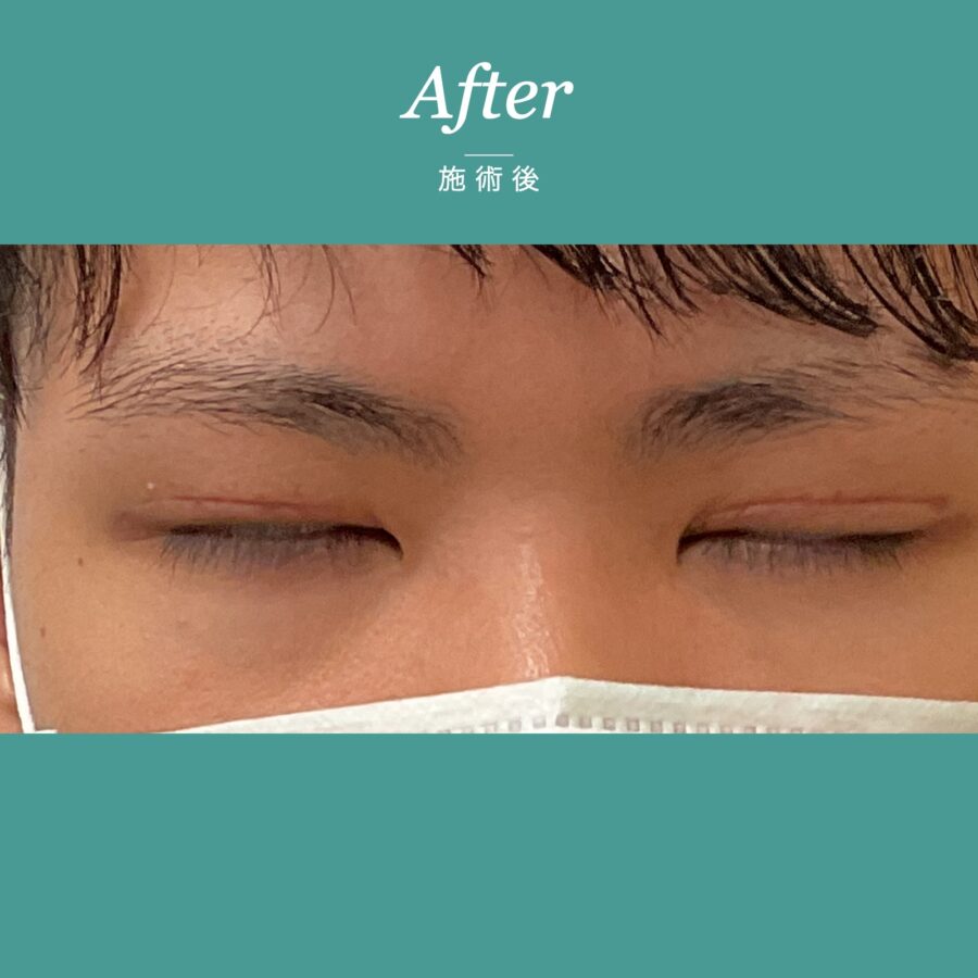 眼瞼下垂（上まぶたが黒目に軽くかかる事例） 施術後（2枚目）