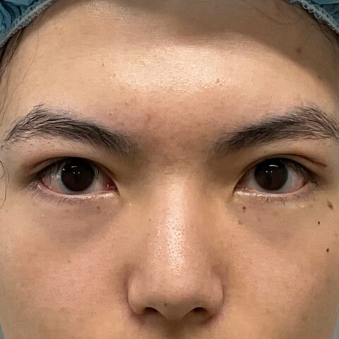 眼瞼下垂（保険適用：黒目の露出が少ないお悩みの事例） 施術後