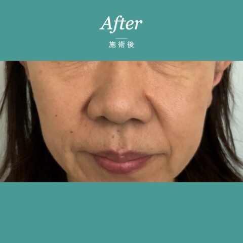 ほくろ除去(顔の複数のほくろを切開法とくり抜き法で除去した事例) 施術後