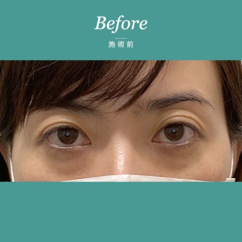 クマ取り(経結膜脱脂:ひふを切らない脂肪取り) 施術前