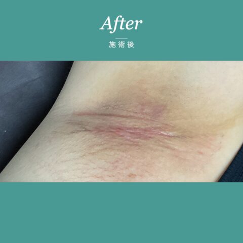 ワキガ（保険適用：皮弁法で脇のにおいを治療した事例） 施術後